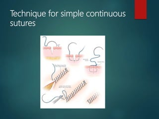 Technique for simple continuous
sutures
 