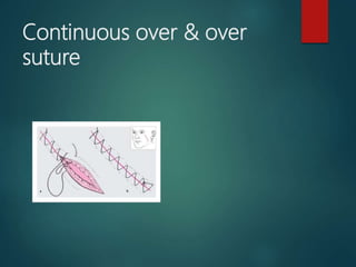 Continuous over & over
suture
 