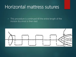 Horizontal mattress sutures
 This procedure is continued till the entire length of the
incision & a knot is then tied.
 