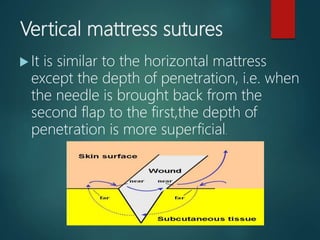 Vertical mattress sutures
 It is similar to the horizontal mattress
except the depth of penetration, i.e. when
the needle is brought back from the
second flap to the first,the depth of
penetration is more superficial.
 