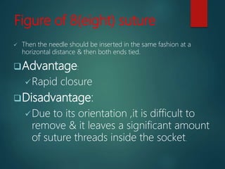 Figure of 8(eight) suture
 Then the needle should be inserted in the same fashion at a
horizontal distance & then both ends tied.
Advantage:
Rapid closure
Disadvantage:
Due to its orientation ,it is difficult to
remove & it leaves a significant amount
of suture threads inside the socket.
 