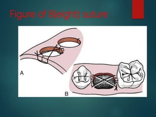 Figure of 8(eight) suture
 