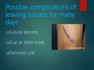 Possible complications of
leaving sutures for many
days
 Sutural abscess.
 Scar or stitch mark.
 Dermoid cyst.
 