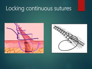 Continuous over & over
suture
 Initially a simple interrupted suture is placed & the needle is then reinserted
in a conti...