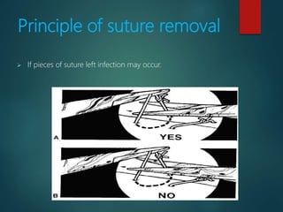 Reasons for failure of
sutures
 Breakage
 Cuts out
 Knot slips
 Extruded suture
 Resorbs too rapidly
 Removed too ea...