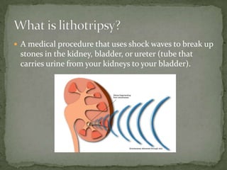  A medical procedure that uses shock waves to break up
 stones in the kidney, bladder, or ureter (tube that
 carries urine from your kidneys to your bladder).
 
