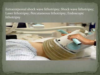 Extracorporeal shock wave lithotripsy; Shock wave lithotripsy;
Laser lithotripsy; Percutaneous lithotripsy; Endoscopic
lithotripsy
 