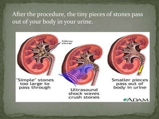 After the procedure, the tiny pieces of stones pass
out of your body in your urine.
 