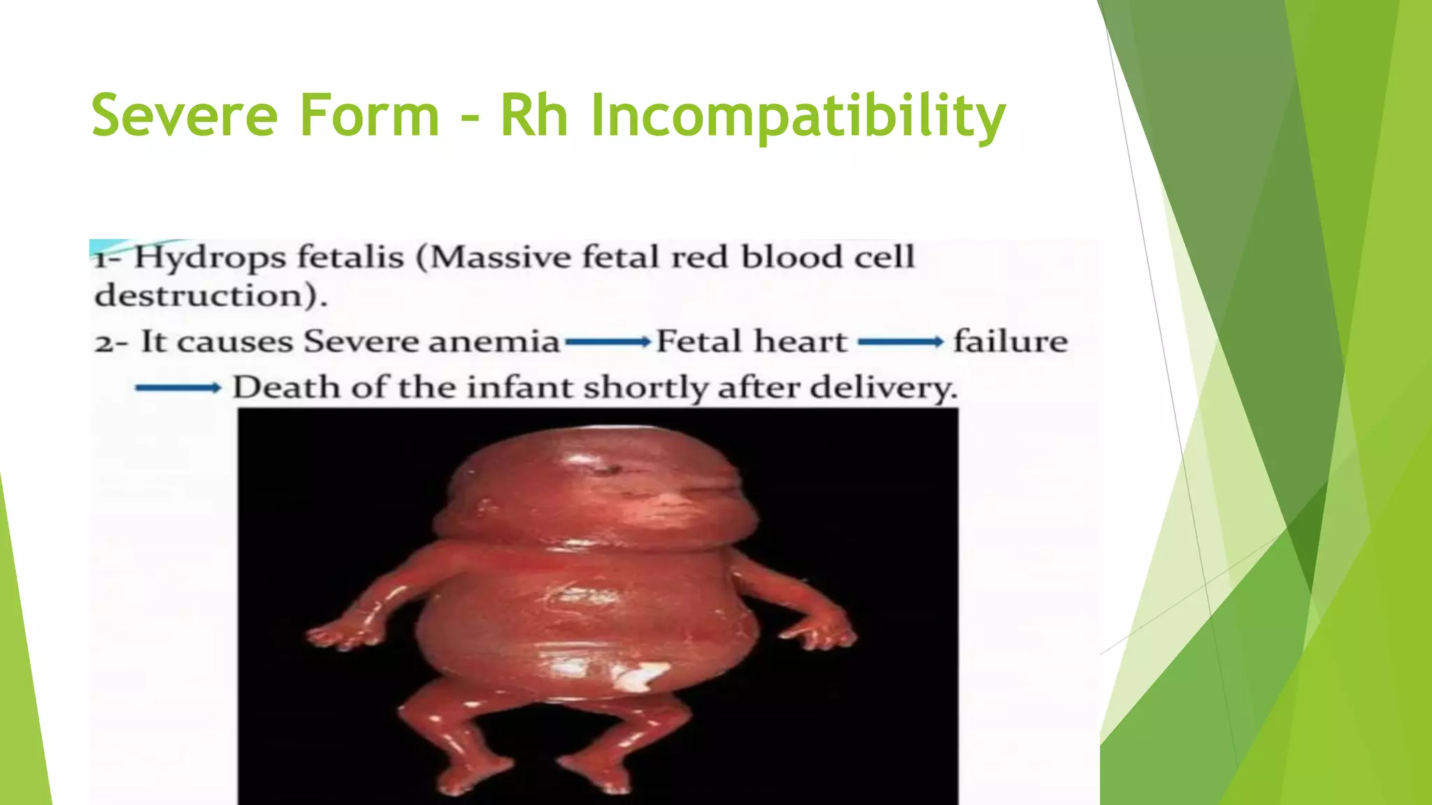 Severe Form – Rh Incompatibility
