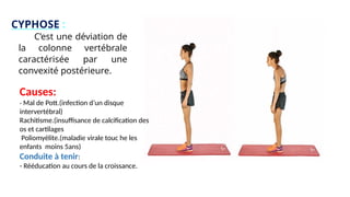 CYPHOSE :
C’est une déviation de
la colonne vertébrale
caractérisée par une
convexité postérieure.
Causes:
- Mal de Pott.(infection d’un disque
intervertébral)
Rachitisme.(insuffisance de calcification des
os et cartilages
Poliomyélite.(maladie virale touc he les
enfants moins 5ans)
Conduite à tenir:
- Rééducation au cours de la croissance.
 