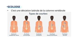 •SCOLIOSE :
• C’est une déviation latérale de la colonne vertébrale.
 