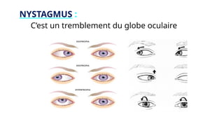 NYSTAGMUS :
C’est un tremblement du globe oculaire
 