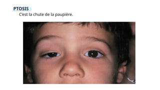 PTOSIS :
C’est la chute de la paupière.
 