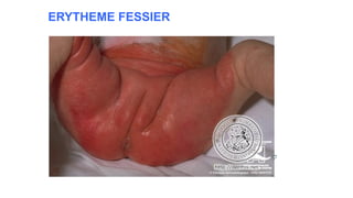 ERYTHEME FESSIER
www.is p
i
t
s.
n
et
 