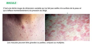 MACULE :
www.is p
i
t
s.
n
et
C’est une tâche rouge de dimension variable qui ne fait pas saillie à la surface de la peau et
qui s’efface momentanément à la pression du doigt.
Les macules peuvent être grandes ou petites, uniques ou multiples.
 