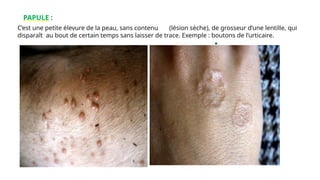 PAPULE :
C’est une petite élevure de la peau, sans contenu (lésion sèche), de grosseur d’une lentille, qui
disparaît au bout de certain temps sans laisser de trace. Exemple : boutons de l’urticaire.
www.is p
i
t
s.
n
et
 