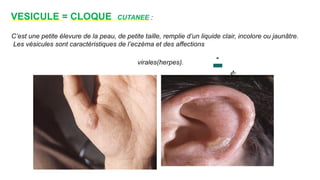 VESICULE = CLOQUE CUTANEE :
www.i
s
p
i
t
s.
n
et
virales(herpes).
C’est une petite élevure de la peau, de petite taille, remplie d’un liquide clair, incolore ou jaunâtre.
Les vésicules sont caractéristiques de l’eczéma et des affections
 