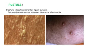 PUSTULE :
C’est une vésicule contenant un liquide purulent.
Les pustules sont souvent entourées d’une zone inflammatoire
www.is p
i
t
s.
n
et
 