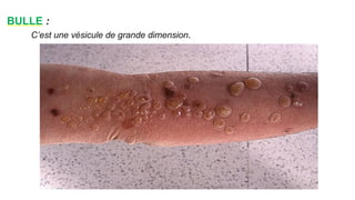 BULLE :
C’est une vésicule de grande dimension.
www.i
s
p
i
t
s.
n
et
 