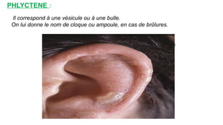 www.is
p
it
s.
n
e t
PHLYCTENE :
Il correspond à une vésicule ou à une bulle.
On lui donne le nom de cloque ou ampoule, en cas de brûlures.
 