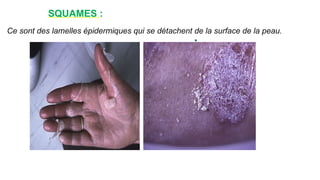 SQUAMES :
Ce sont des lamelles épidermiques qui se détachent de la surface de la peau.
www.
is
p
i
t
s.
n
et
 