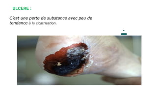 ULCERE :
C’est une perte de substance avec peu de
tendance à la cicatrisation.
 