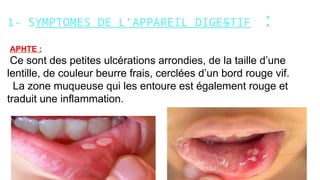 1- SYMPTOMES DE L’APPAREIL DIGESTIF :
APHTE :
Ce sont des petites ulcérations arrondies, de la taille d’une
lentille, de couleur beurre frais, cerclées d’un bord rouge vif.
La zone muqueuse qui les entoure est également rouge et
traduit une inflammation.
 