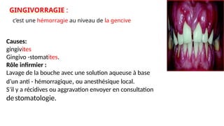 www.
is
p
i
t
s.
n
et
www.
is
p
i
t
s.
n
et
GINGIVORRAGIE :
c’est une hémorragie au niveau de la gencive
Causes:
gingivites
Gingivo -stomatites.
Rôle infirmier :
Lavage de la bouche avec une solution aqueuse à base
d’un anti - hémorragique, ou anesthésique local.
S’il y a récidives ou aggravation envoyer en consultation
destomatologie.
 