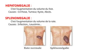 HEPATOMEGALIE :
C’est l’augmentation du volume du foie.
Causes : Cirrhose, Tumeur, Kyste, Abcès.
SPLENOMEGALIE :
C’est l’augmentation du volume de la rate.
Causes : Infection,, Leucémie…
 
