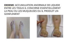 OEDEME :ACCUMULATION ANORMALE DE LIQUIDE
ENTRE LES TISSUS IL CONCERNE ESSENTIELLEMENT
LA PEAU OU LES MUQUEUSES OU IL PRODUIT UN
GONFLEMENT
 