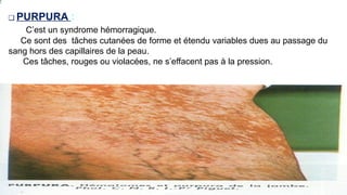 ❑ PURPURA :
C’est un syndrome hémorragique.
Ce sont des tâches cutanées de forme et étendu variables dues au passage du
sang hors des capillaires de la peau.
Ces tâches, rouges ou violacées, ne s’effacent pas à la pression.
www.is p
i
t
s.
n
et
 