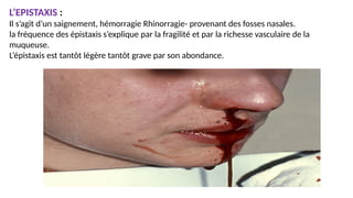 L’EPISTAXIS :
Il s’agit d’un saignement, hémorragie Rhinorragie- provenant des fosses nasales.
la fréquence des épistaxis s’explique par la fragilité et par la richesse vasculaire de la
muqueuse.
L’épistaxis est tantôt légère tantôt grave par son abondance.
 