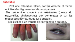 CYANOSE :
C’est une coloration bleue, parfois violacée et même
noirâtre des téguments et des muqueuses .
Elle prédomine souvent aux extrémités (pointe du
nez,oreilles, phalangettes), aux pommettes et sur les
muqueuses (lèvres, muqueuse buccale).
Elle est liée à un trouble de l’oxygénation du sang.
 