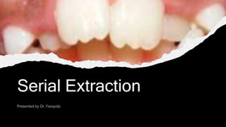 Serial Extraction
Presented by Dr. Farayola
 