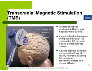 Transcranial Magnetic Stimulation
(TMS)
 The treatment coil
produces MRI-strength
magnetic field pulses.
 Magnetic field pulses pass
unimpeded through the
cranium for 2-3 cm. and
induce a small electric
current.
 Induced electric currents
stimulate the firing of
nearby neurons, causing
the release of
neurotransmitters and
clinical effects.
Faraday (1839) Experimental Research in Electricity. Vol 1; Barker (1991) J Clin Neurophysiol; Barker (1985) Lancet
41
A
Proven
Approach
 