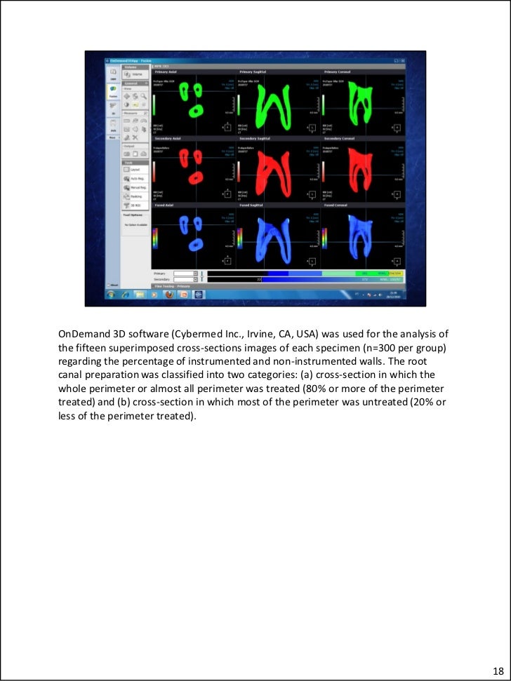Flatoval root canal preparation with SelfAdjusting File instrument…