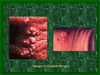 14
Images of Genital Herpes
 