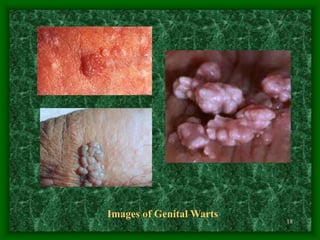 18
Images of Genital Warts
 