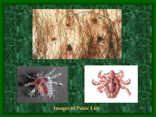 23
Images of Pubic Lice
 