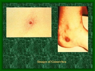7
Images of Gonorrhea
 