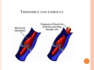 THROMBUS AND EMBOLUS
 