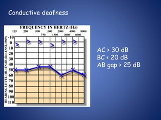 Conductive deafness
AC > 30 dB
BC < 20 dB
AB gap > 25 dB
 