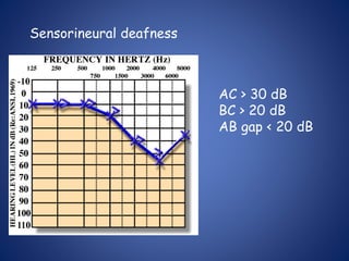 Sensorineural deafness
AC > 30 dB
BC > 20 dB
AB gap < 20 dB
 