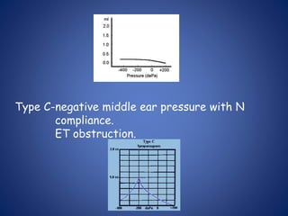 Type C-negative middle ear pressure with N
compliance.
ET obstruction.
 