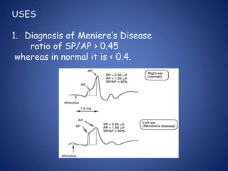 USES
1. Diagnosis of Meniere’s Disease
ratio of SP/AP > 0.45
whereas in normal it is < 0.4.
 