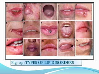 Translabial drug delivery system | PPTX