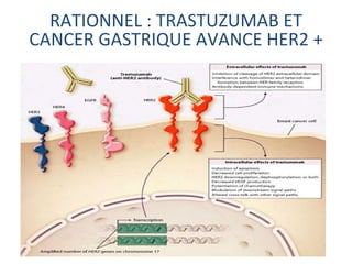 RATIONNEL : TRASTUZUMAB ET
CANCER GASTRIQUE AVANCE HER2 +
 