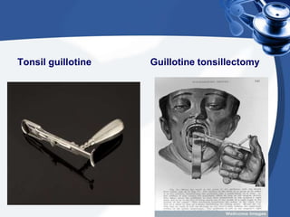 Tonsil guillotine   Guillotine tonsillectomy
 