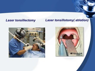 Laser tonsillectomy   Laser tonsillotomy( ablation)
 