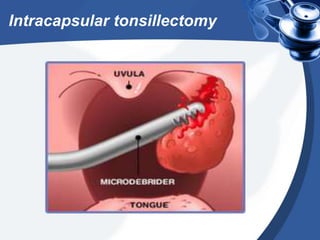 Intracapsular tonsillectomy
 